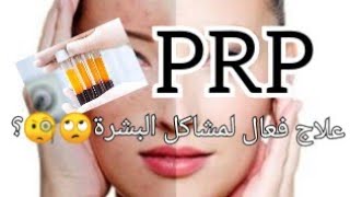 هل علاج PRP عنده فعالية؛ هل يمكن الاعتماد عليه كعلاج لمشاكل البشرة️