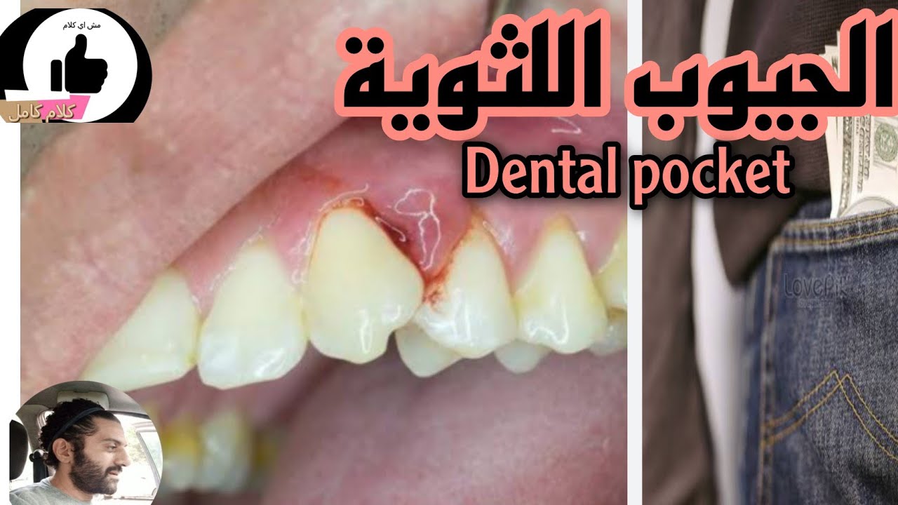 الجيوب اللثوية ( Dental pocket ) YouTube