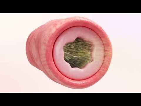 Video: Kas ir fibrozējošā kolonopātija?