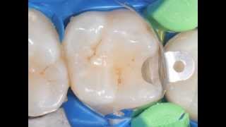 First 10 consecutive cases with Triodent V3 Sectional Matrix.