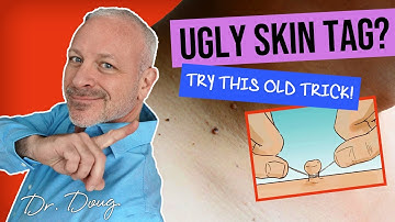 GET RID OF UGLY SKIN TAG! 🔴 Tie with a STRING!