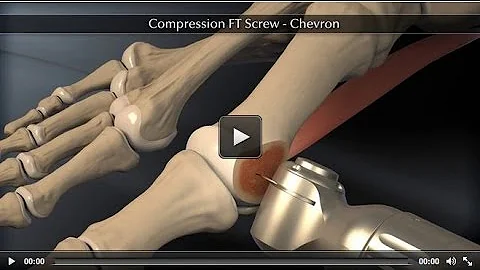 Headless Compression Screw – Chevron Animation