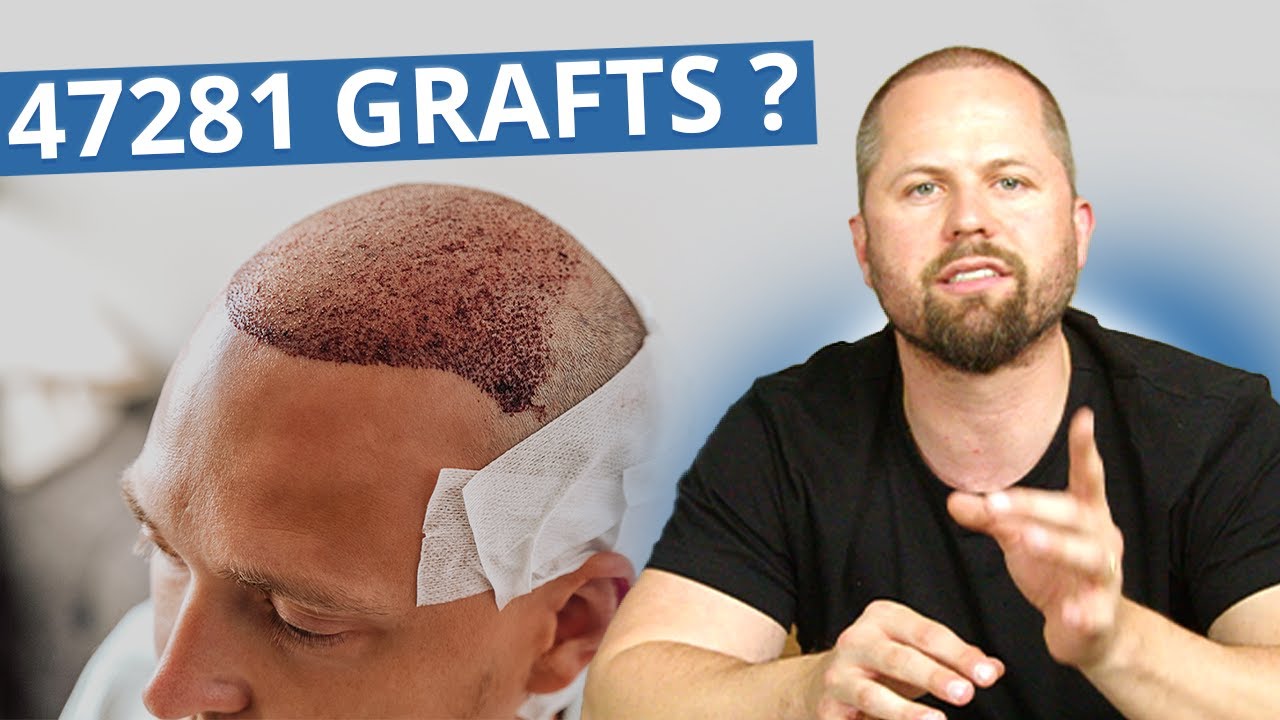 Haartransplantation: Was ist ein Graft? [Follikuläre Einheit]