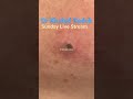 Massive Blackhead Extraction Blackheads Skincare Dr Khaled Sadek Massive Blackhead Extraction Blackheads Skincare Dr Khaled Sadek