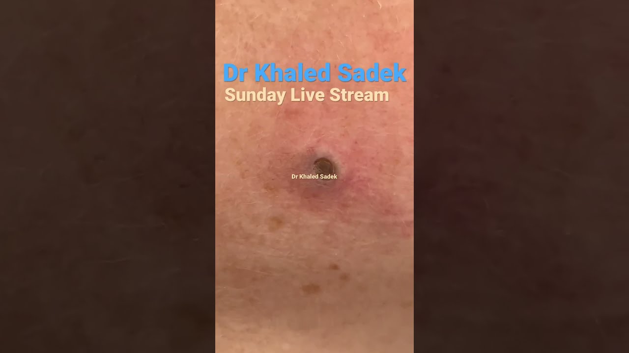 Massive Blackhead Extraction Blackheads Skincare Dr Khaled Sadek