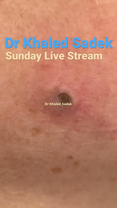 Massive blackhead extraction #blackheads #skincare Dr Khaled Sadek