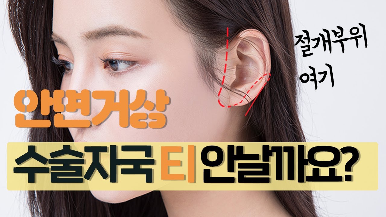 안면거상 아무리 헤어라인이어도 수술자국 티가 안날까요? — 유튜브 영상 썸네일