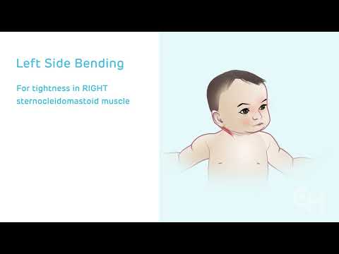 Congenital Muscular Torticollis: