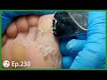 Ep.230 - Satisfying Big Blade Chops Off Dead Skin Off Foot