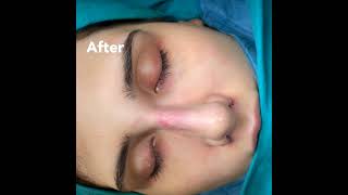 Hard Case | Female Rhinoplasty