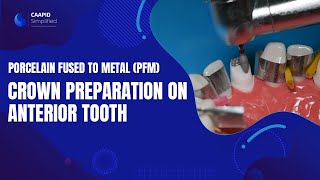 Porcelain Fused to Metal (PFM) Crown Preparation on Anterior Tooth | Full Course on Link Below