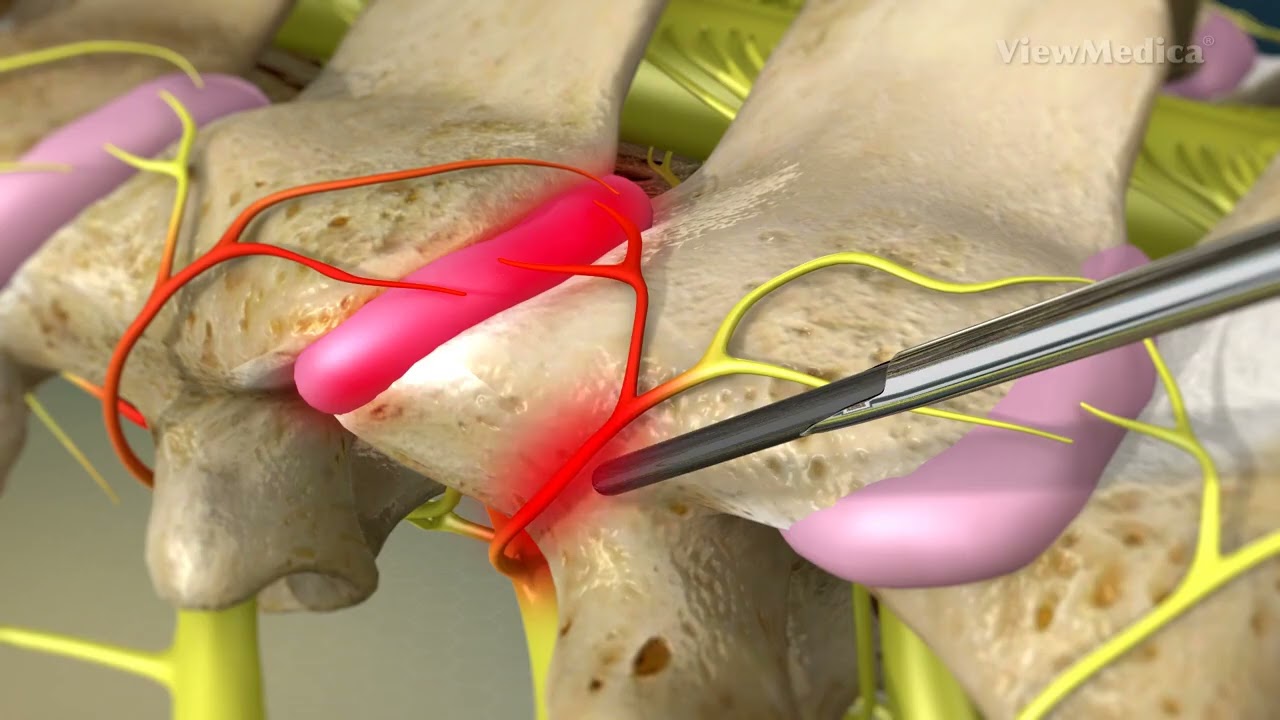 Cervical Facet Radiofrequency Neurotomy video