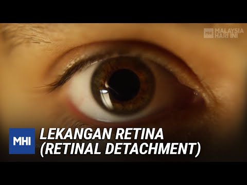 Video: Adakah retina yang tercabut menyebabkan kesakitan?