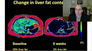 Roy Taylor diabetes lecture, fatty liver & weight loss