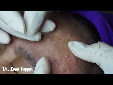 Acne Blackheads Whiteheads removals on face part  | How to get rid of blackheads easy