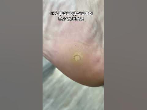 Безопасное удаление подошвенных бородавок 👣 - YouTube