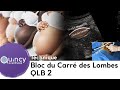 Bloc du carr de lombes quadratus lumborum block de type 2 qlb 2