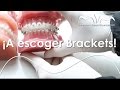 Ortodoncia ideal: TIPOS DE BRACKETS | Ortodoncia MVM en Bogotá - Colombia