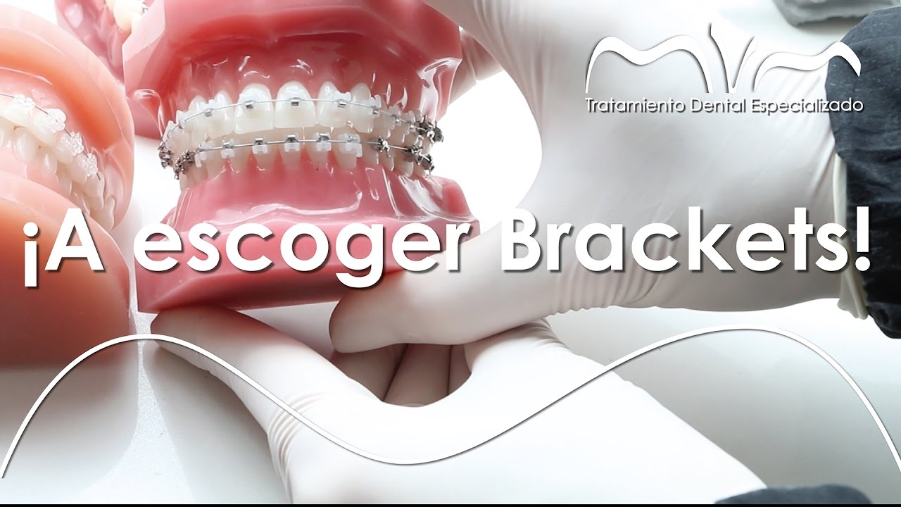 Ortodoncia ideal: TIPOS DE BRACKETS | Ortodoncia MVM en Bogotá - Colombia