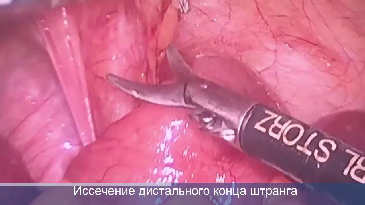 Лапароскопия кишечника. Странгуляционная кишечная непроходимость