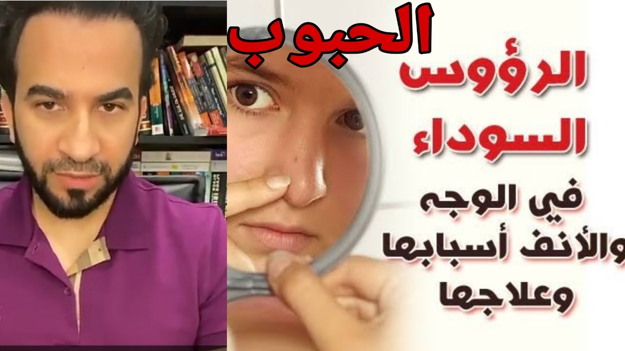 حبوب الوجه والرؤوس السوداء حل نهائي في المنزل - دكتور طلال