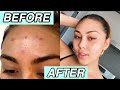 SKINCARE ROUTINE THAT CHANGED MY SKIN✨ *clear and glowy skin*