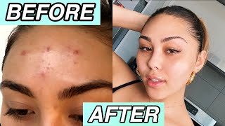 SKINCARE ROUTINE THAT CHANGED MY SKIN✨ *clear and glowy skin*