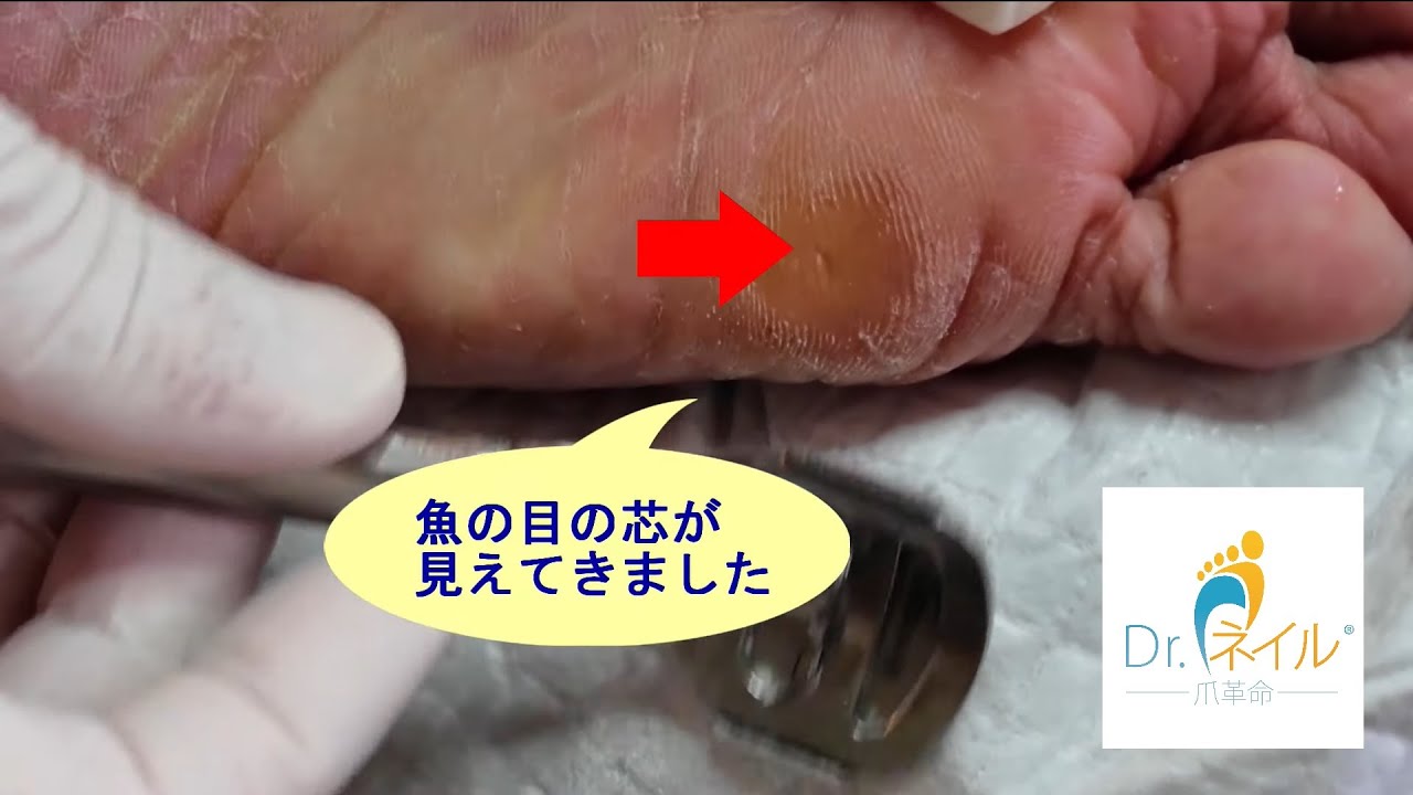 タコケア うおのめケア 胼胝 Callus Removal 문어 脚茧护理 鶏眼 Corn Removal 티눈 鸡眼护理 006 Youtube タコケア うおのめケア 胼胝 Callus Removal 문어 脚茧护理 鶏眼 Corn Removal 티눈 鸡眼护理 006 Youtube