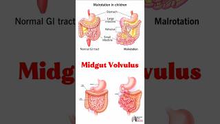Midgut Volvulus #medical #animation #3d #short | Biology with Aliya