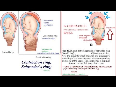 Protraction and arrest disorders Dr S khazardoost Associate professor of  OB&GYN Perinatalogy Department TUMS. - ppt download