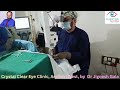 Dr. Jignesh Gala, renowned vitreoretinal specialist, is performing a complex case of nucleus drop