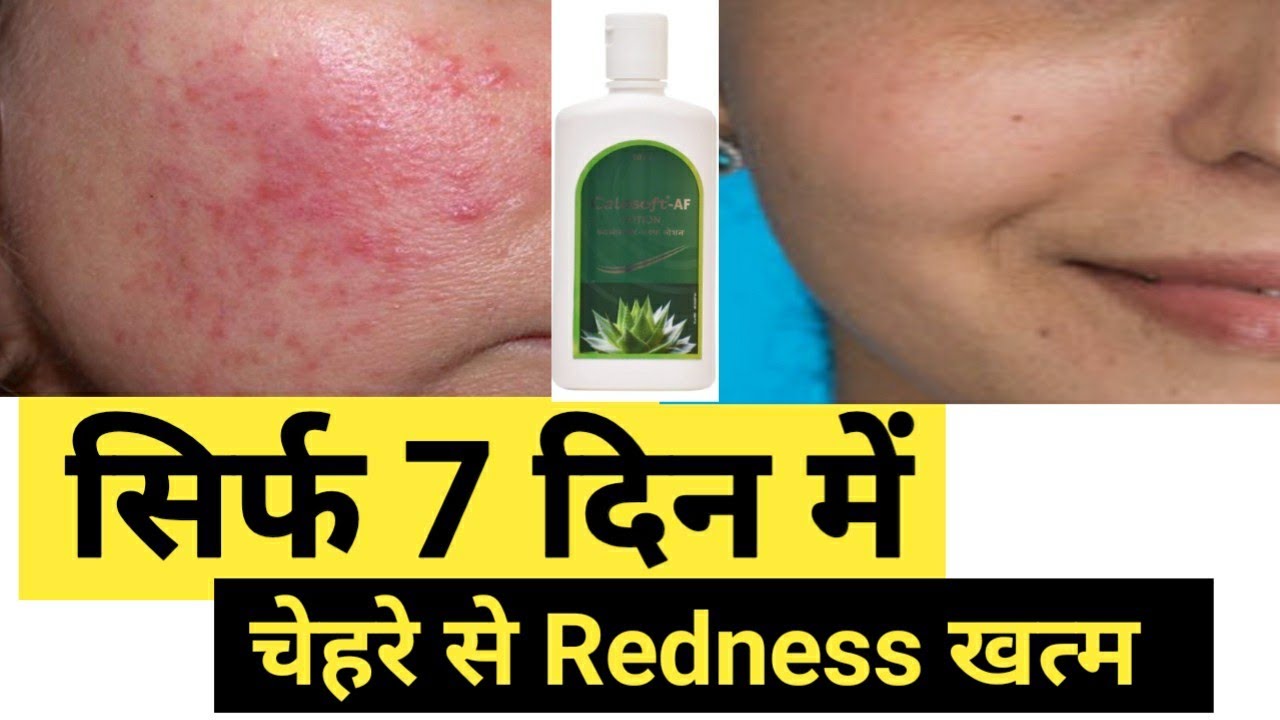 Steroid Cream side effects treatment Cure Steorid Cream Side Effects