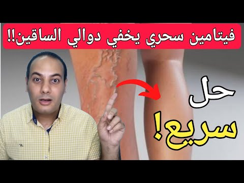 أكتشاف صادم تعاني من الدوالي فيتامين سحري يخلصك نهائيا من دوالي الساقين بدون جراحه او ادويه