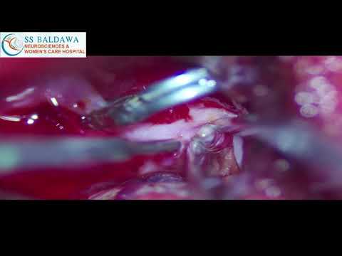 MCA aneurysm clipping