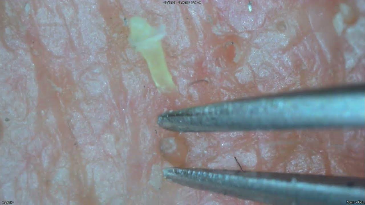0148 keratin plug removal chin YouTube