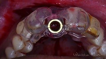 Osseodensification + GBR