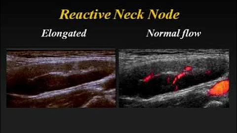 Ultrasound of Cervical Lymph Nodes - DayDayNews