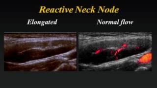 Ultrasound of Cervical Lymph Nodes