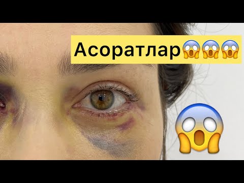 Блефаропластикадан кейинги асоратлар. Осложнения после блефаропластике￼