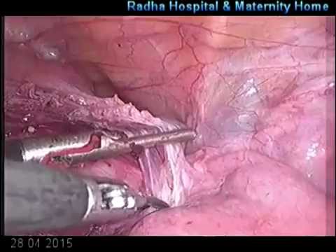 Total Laparoscopic Hysterectomy Step
