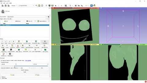 3dslicer infected bone cut