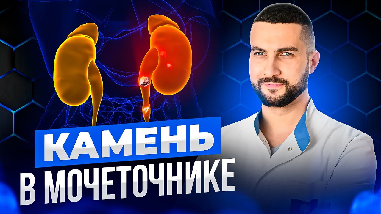 что вызывает выход камня из почек