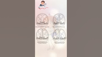 Types of Twin pregnancy #nursingnotes #nursing #shorts #twins
