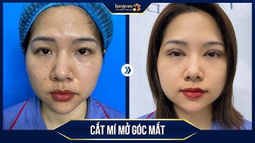 Cắt mí + mở góc mắt trong: Giải pháp hoàn hảo cho đôi mắt to đẹp