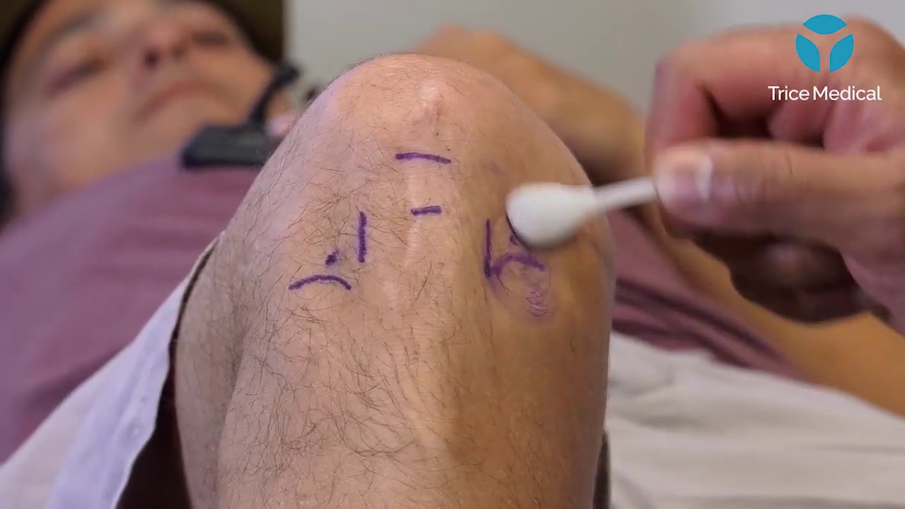 Dr. Nirav Amin l mieye Knee Technique YouTube