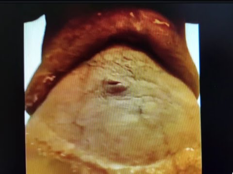 Pregnant Woman Who's Pregnant With A Botched Tummy Tuck - YouTube
