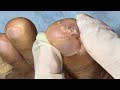 Ep_6377 Foot nails skin removal 👣 พี่..ขอตัวช่วยอีกที 😄 (clip from Thailand)