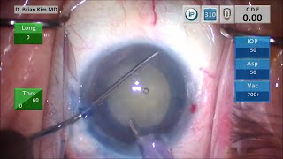 TBWTDCS #64: Dense White Cataract, Trypan Blue, Anterior Capsule Tear with the Chopper