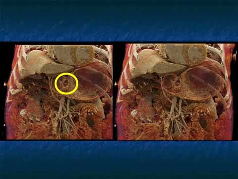 CT Evaluation of