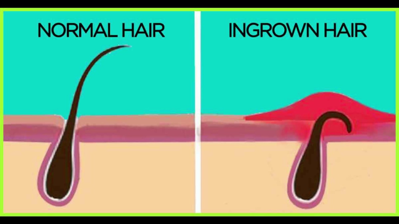 How to Get Rid of Ingrown Hair । Ingrown Hair Removal at